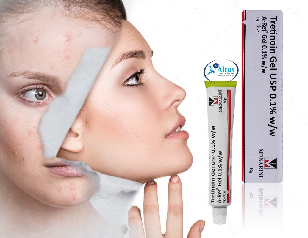 Tretinoin 0.1 Cream: The Holy Grail of Skincare Revealed!