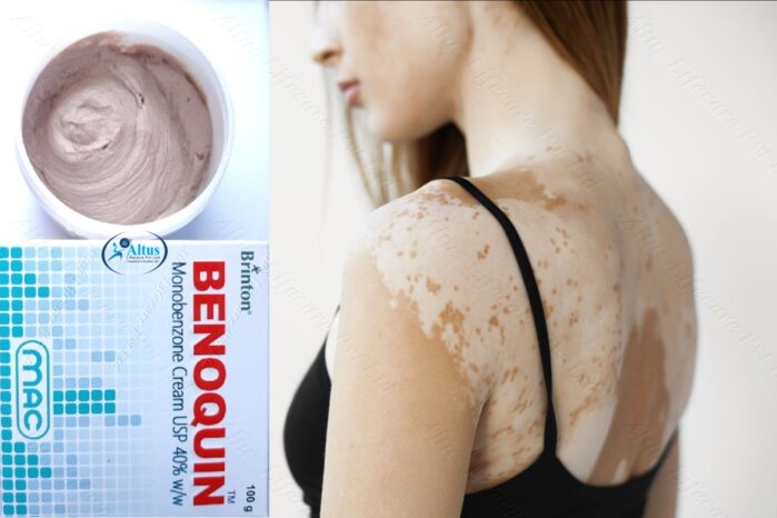 Say Goodbye to Vitiligo Spots Forever with Benoquin Cream – It Works!