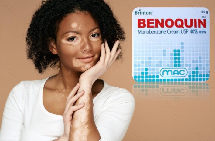 Monobenzone Cream: The Breakthrough Treatment for Vitiligo You Need to Try Now!