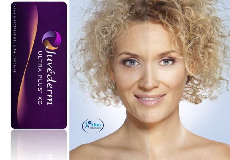 Juvederm Ultra XC Injection 4 1