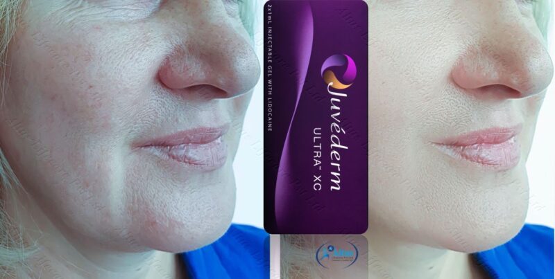 Juvederm Ultra XC Injection 4