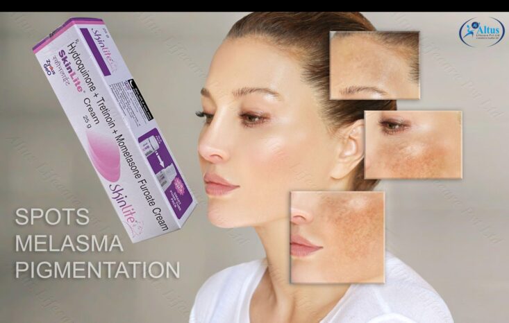 Unlocking the Pigmentation on Face: How Skinlite Cream Transforms Your Beauty Routine
