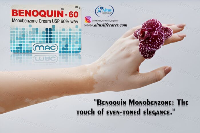 Benoquin 60 Cream for Vitiligo