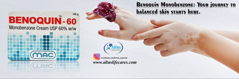 Benoquin 60 Cream for Vitiligo