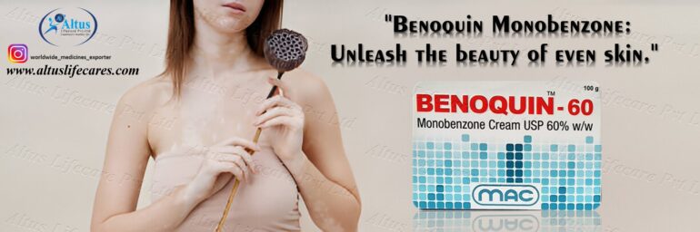 Benoquin 60 Cream for Vitiligo